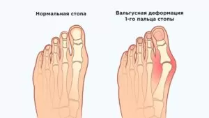 лечение вальгусной деформации стопы,Алматы,консультация,хирургическое лечение,консервативное лечение,опытные врачи,Hallux Valgus