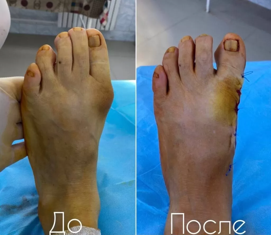 hallux valgus актау