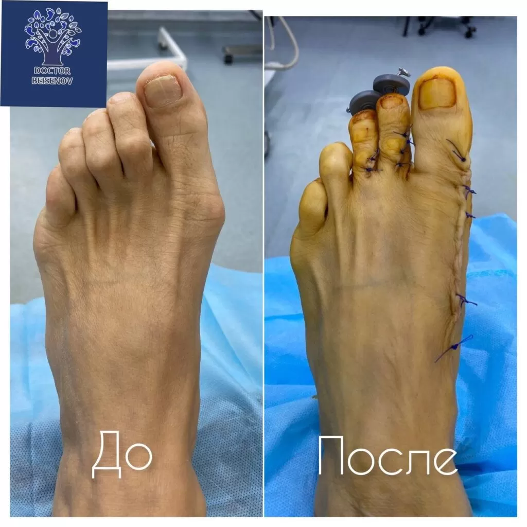 hallux valgus актобе