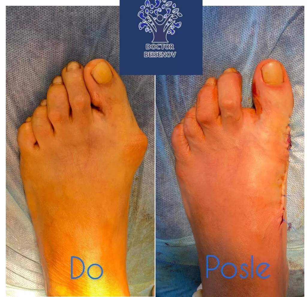 hallux valgus алматинская область