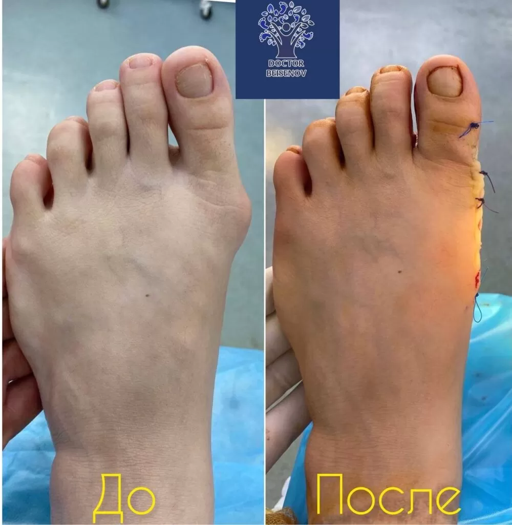 hallux valgus almaty