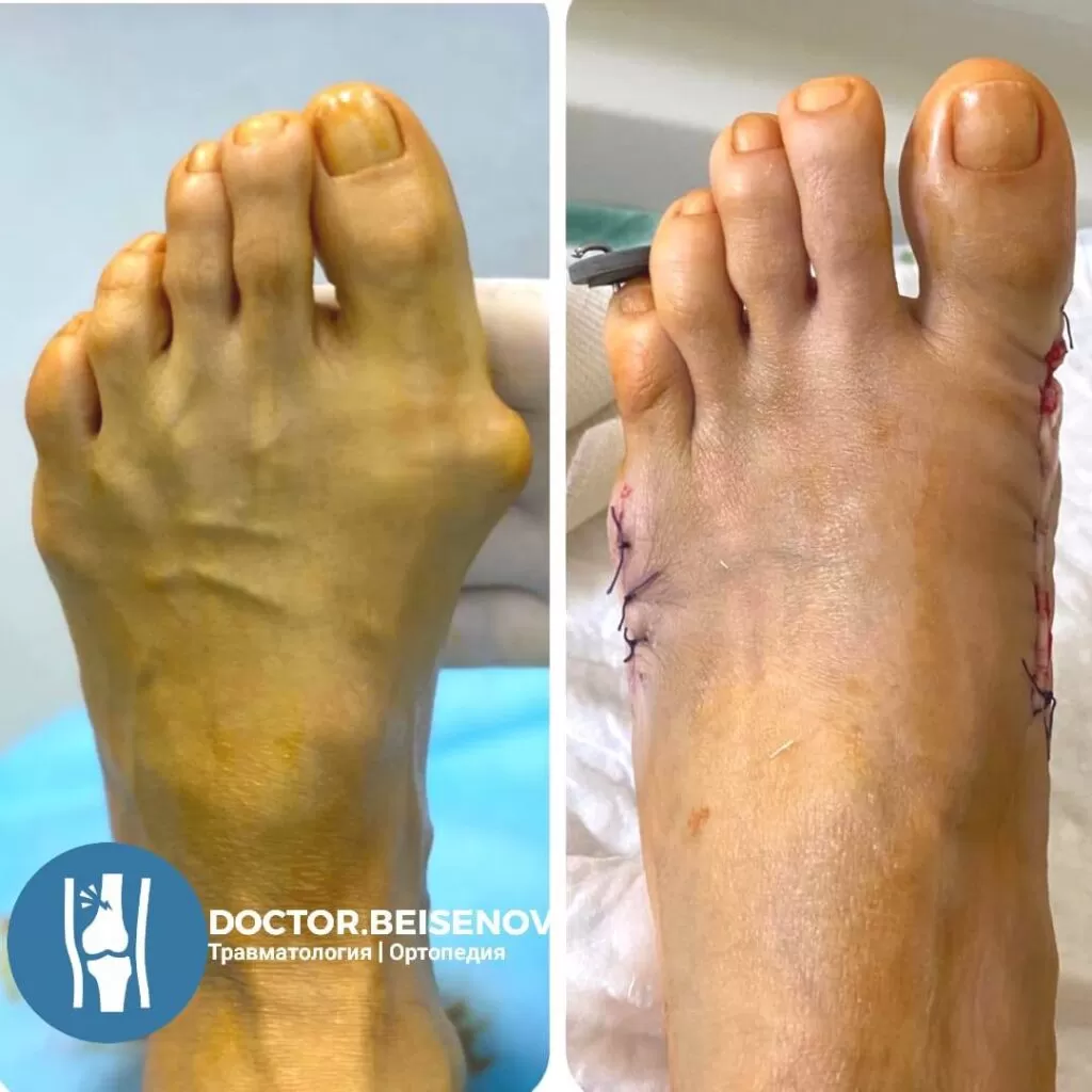 hallux valgus астана