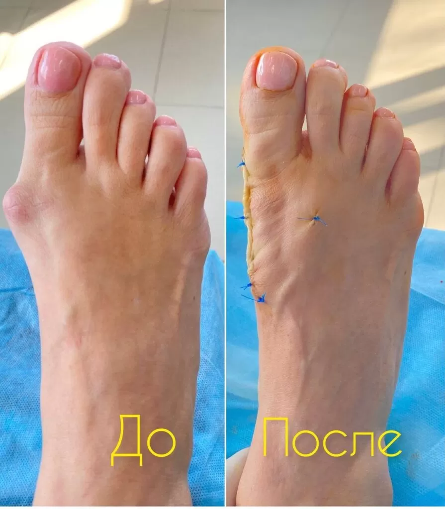 hallux valgus astana