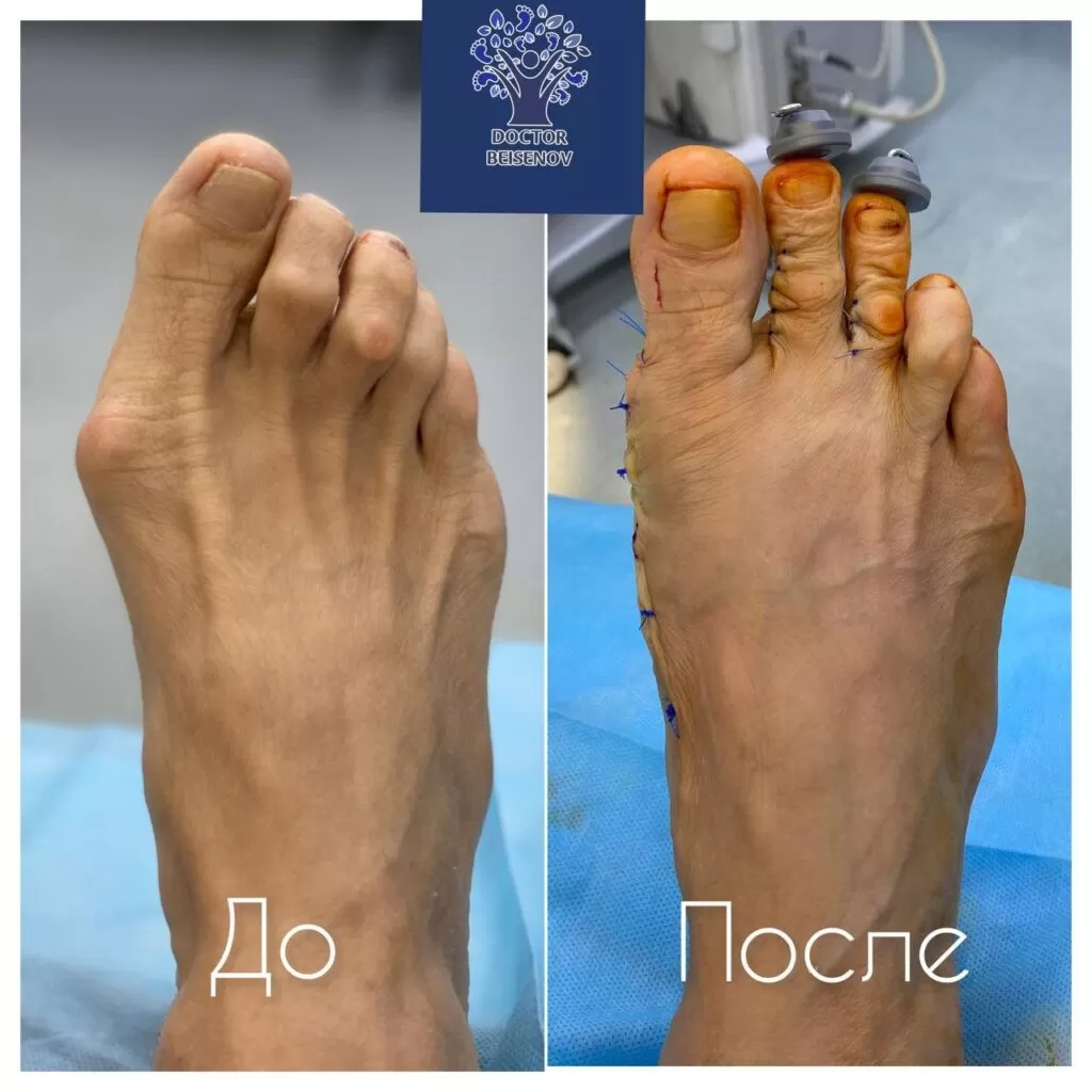 hallux valgus атырау