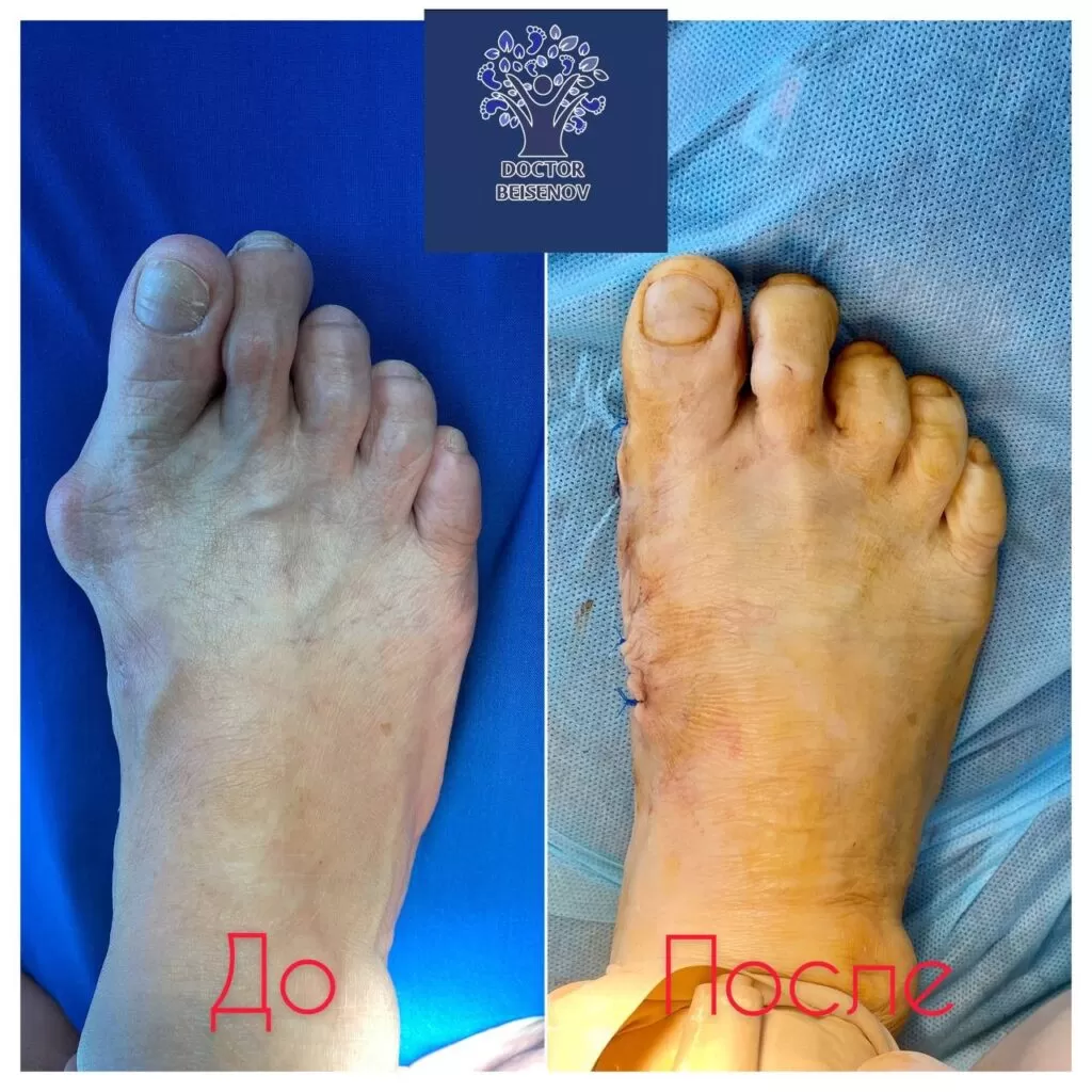 hallux valgus бишкек
