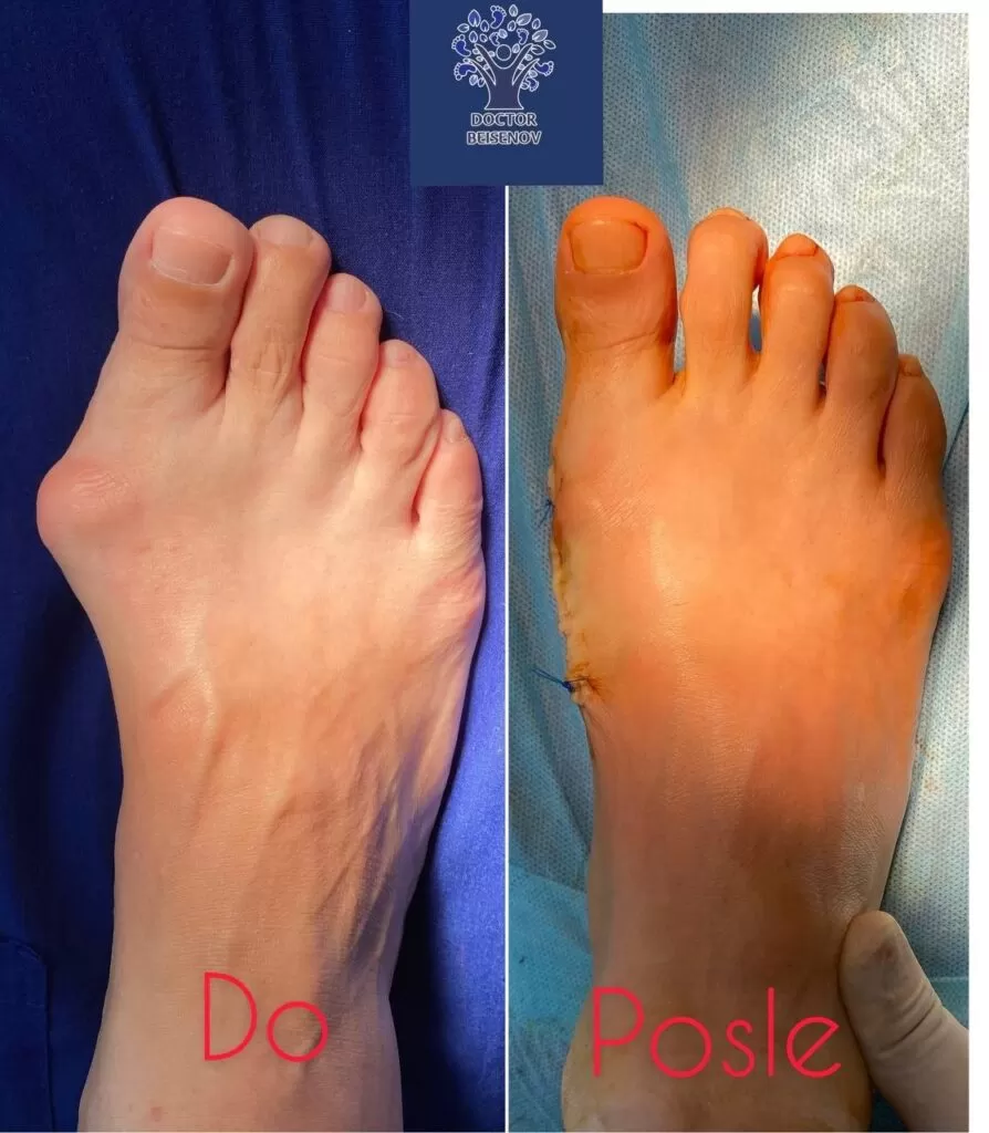 hallux valgus г. астана