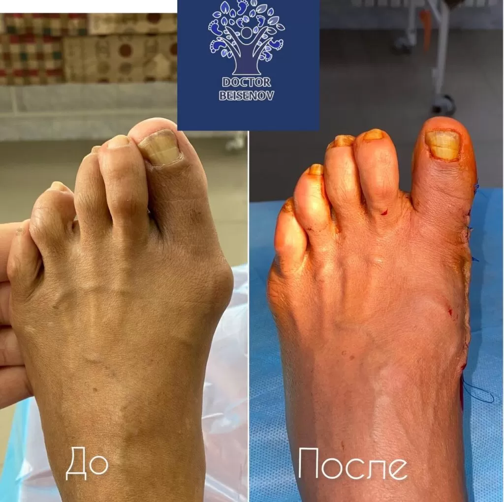 hallux valgus караганда