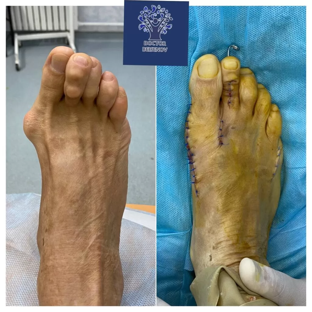 hallux valgus каскелен