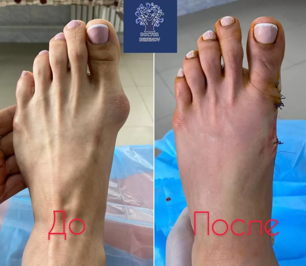 hallux valgus кокшетау