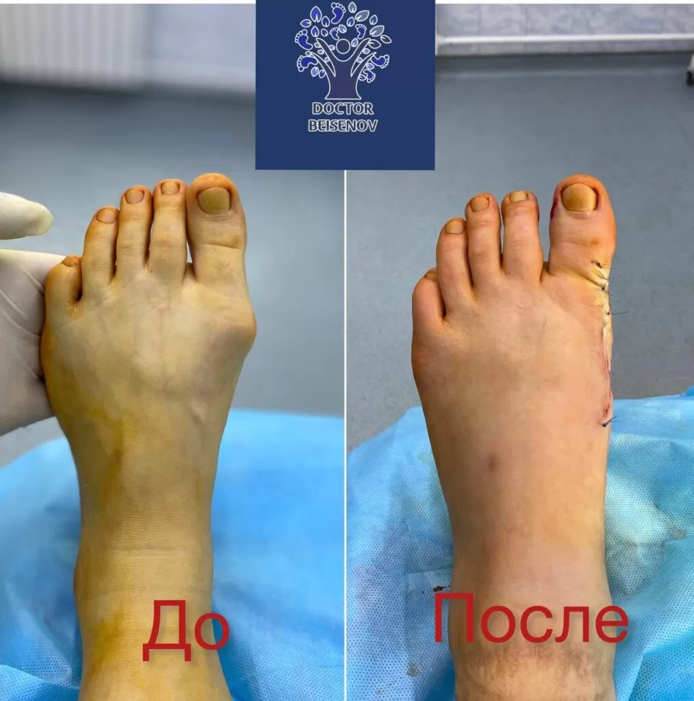 hallux valgus кызылорда