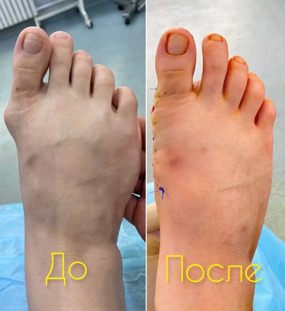 hallux valgus kz