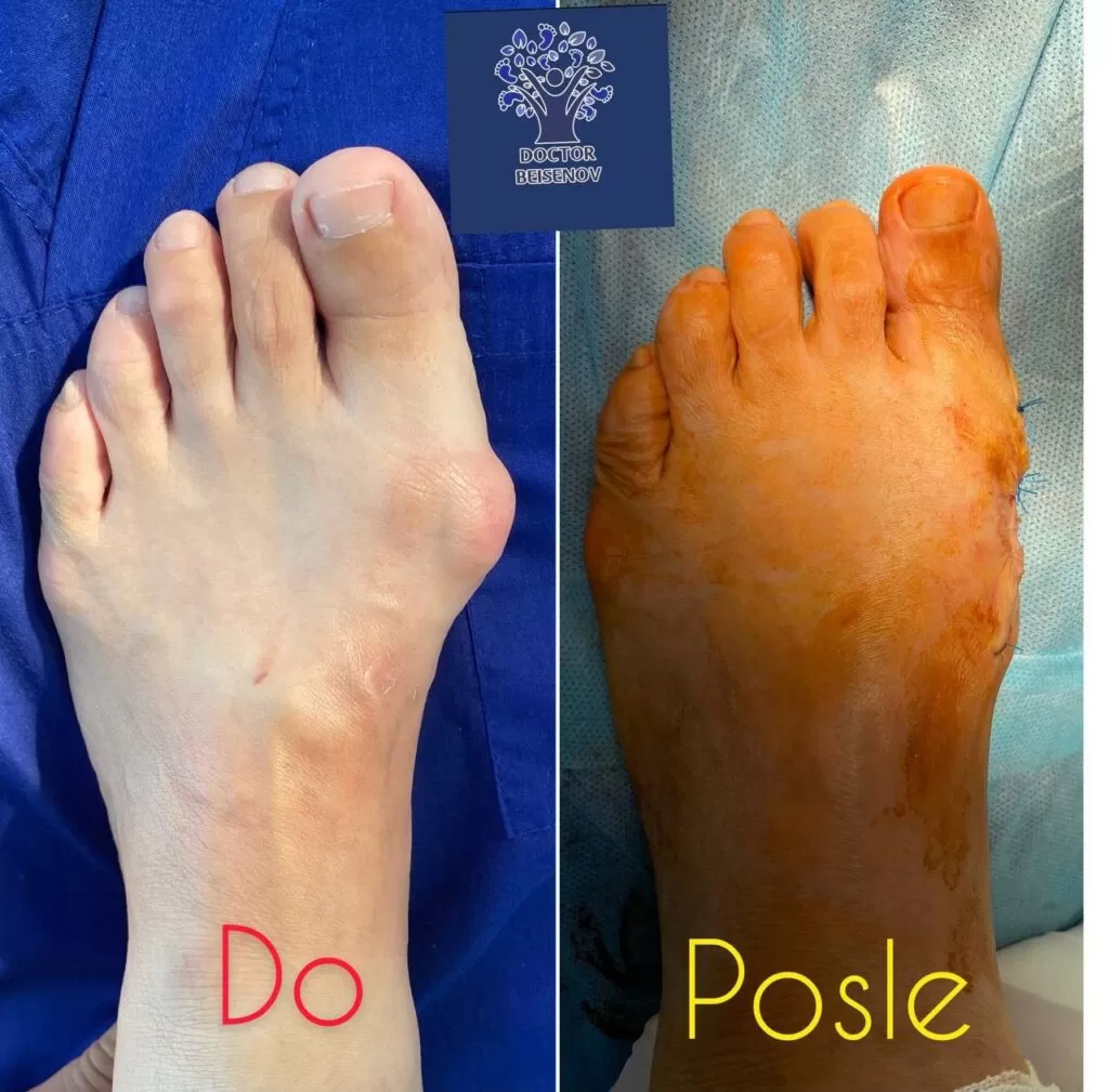 hallux valgus нурсултан