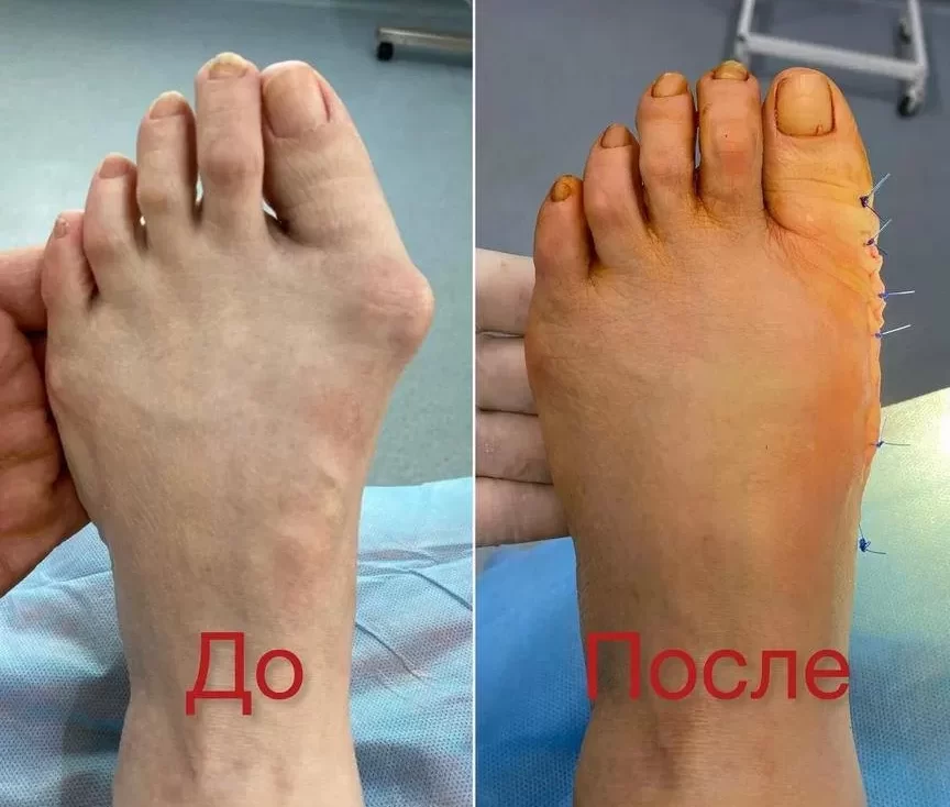hallux valgus оскемен