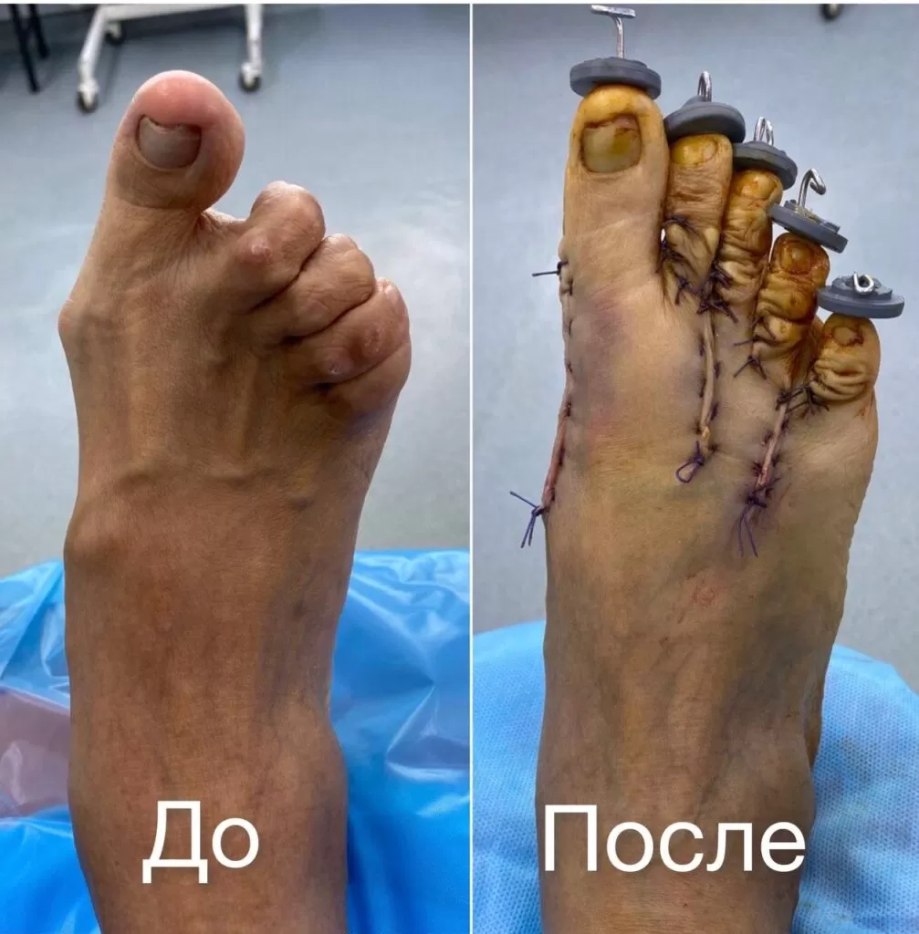 hallux valgus павлодар