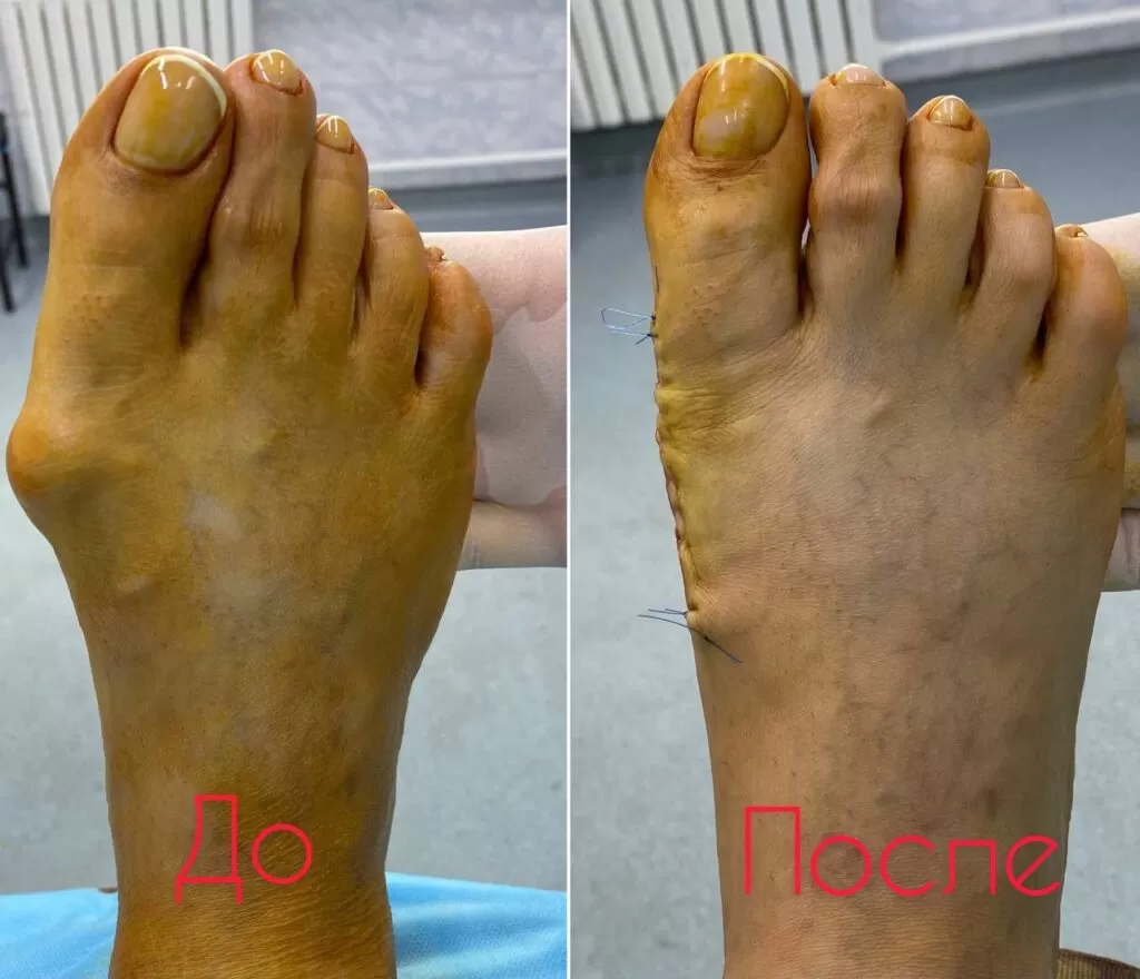 hallux valgus петропавлск