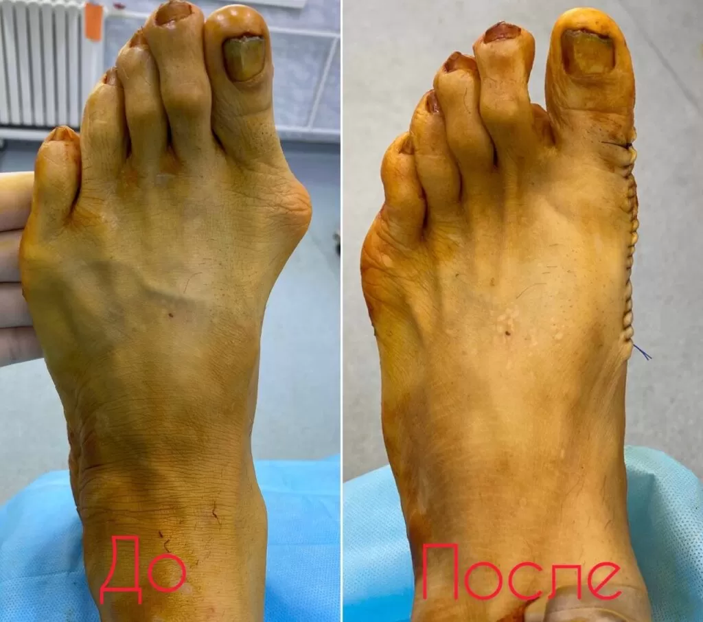 hallux valgus семей