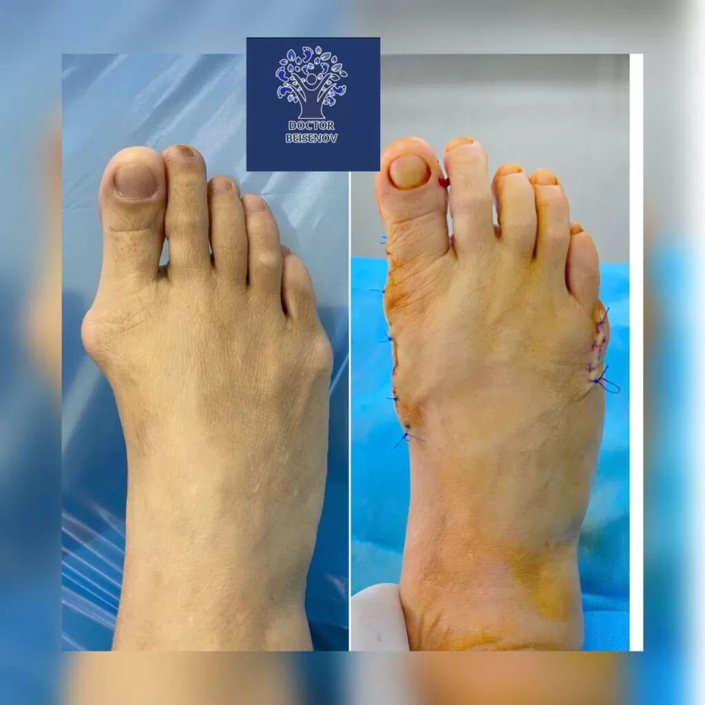 hallux valgus shymkent