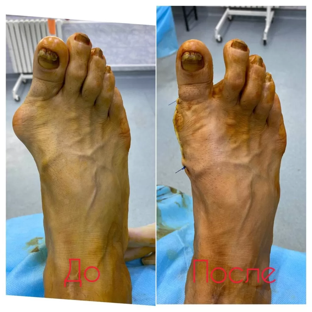 hallux valgus талдыкорган