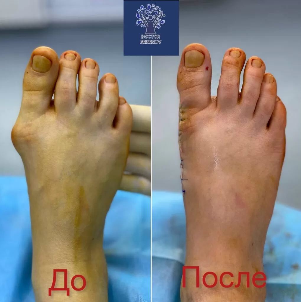 hallux valgus тараз