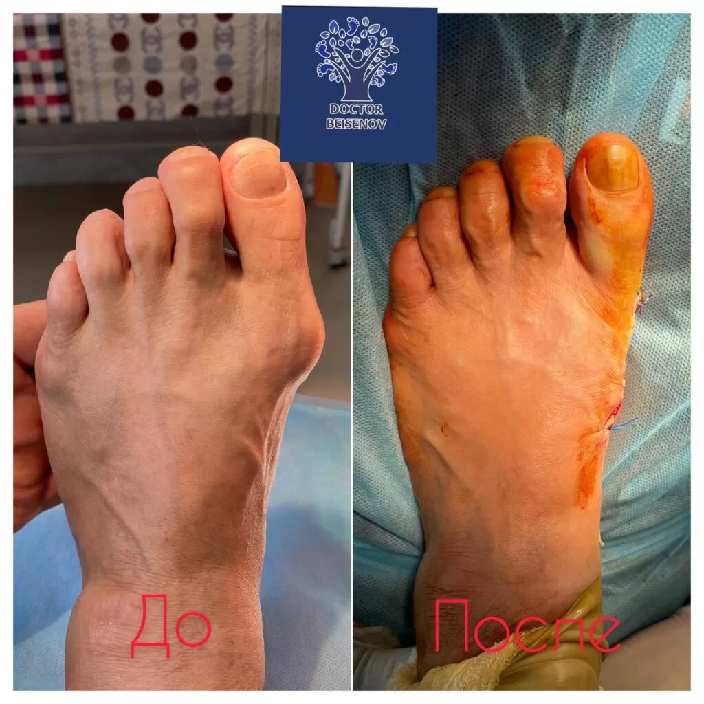hallux valgus ташкент
