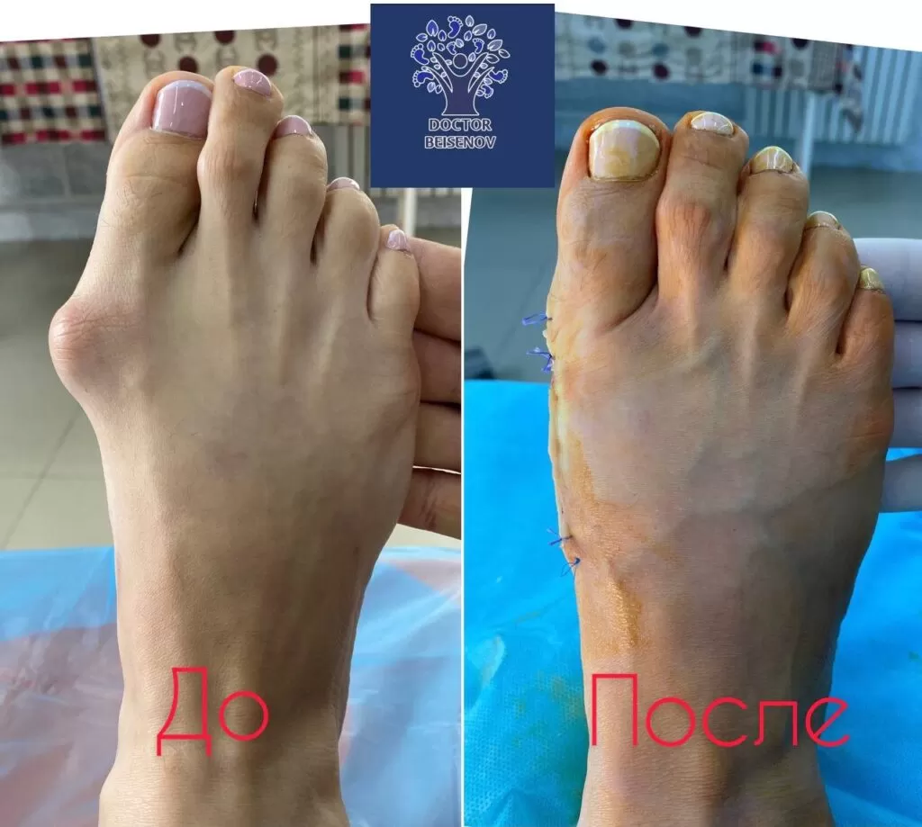 hallux valgus туркестан
