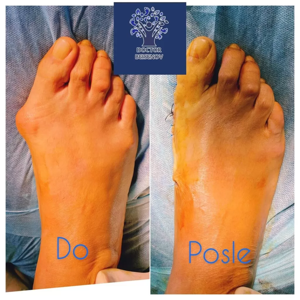 hallux valgus уральск