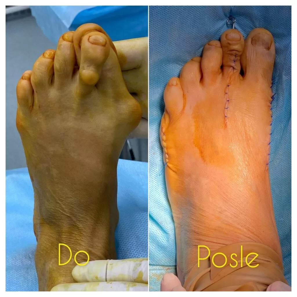 hallux valgus в каскелен