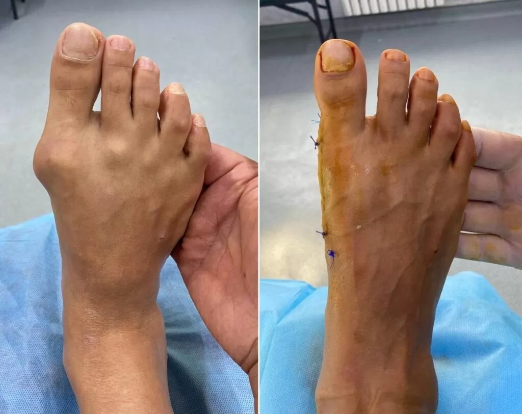 hallux valgus в шымкент