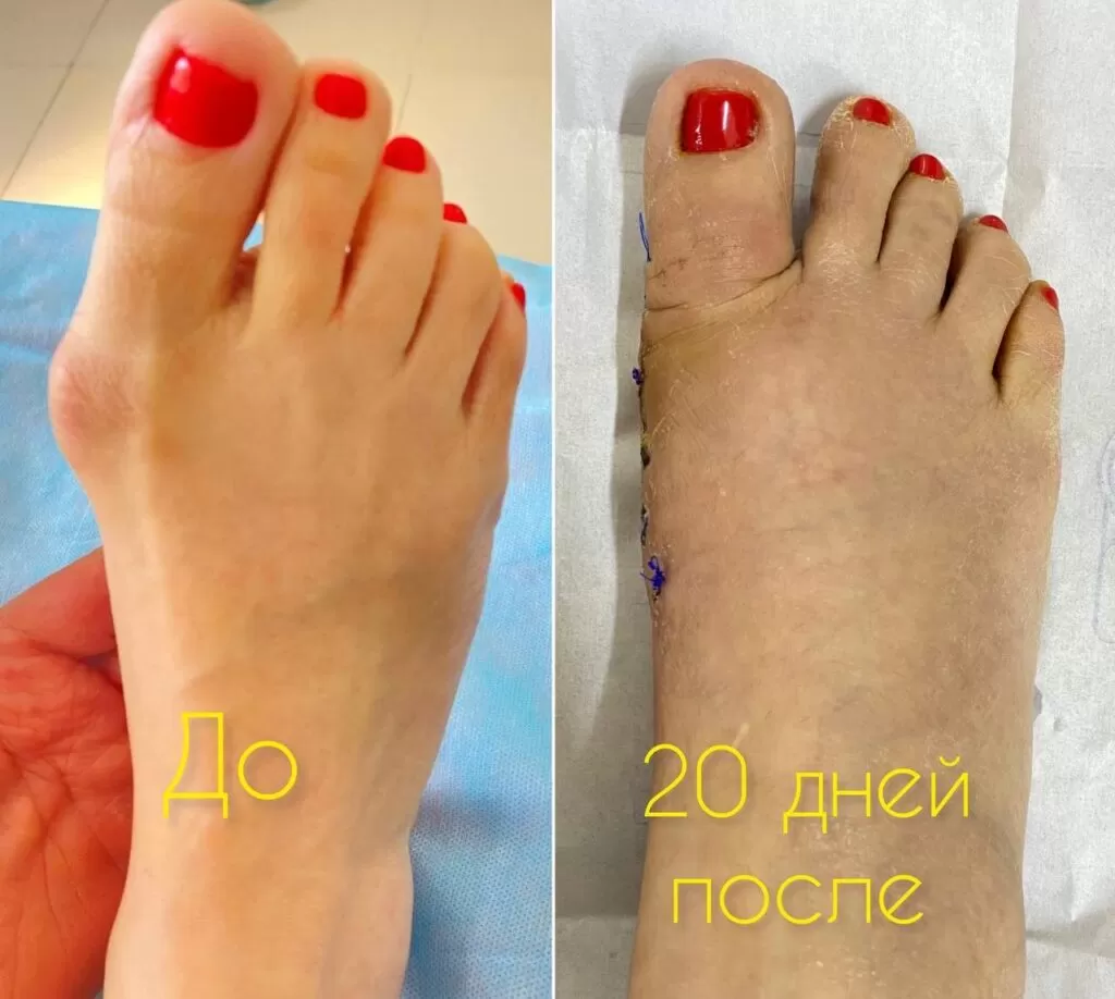Лечение вальгусной деформации стопы в Алматы